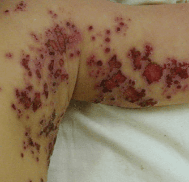 アトピー性皮膚炎の基本情報 Part 2治療についてアトピー性皮膚炎の合併症