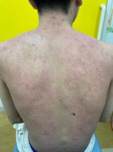 アトピー性皮膚炎の基本情報Part 3予防対策についてアトピー性皮膚炎の症状(思春期・成人期)