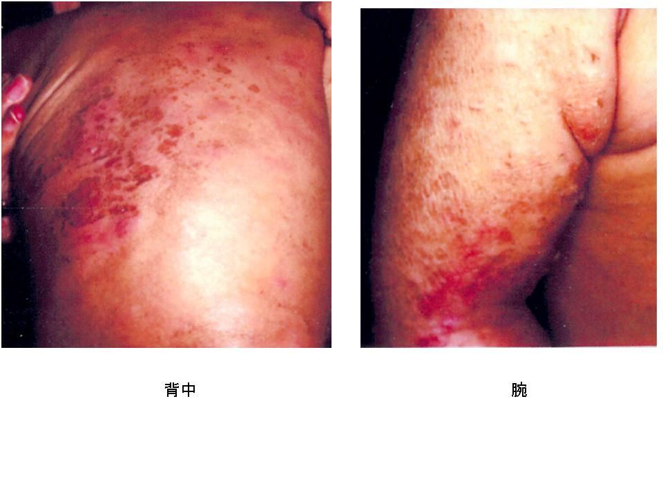 アトピー性皮膚炎の基本情報Part 3予防対策についてアトピー性皮膚炎の症状