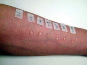 アトピー性皮膚炎の基本情報Part 3予防対策についてパッチテスト