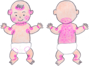 アトピー性皮膚炎の基本情報Part 3予防対策についてアトピー性皮膚炎の部位２(乳児期)