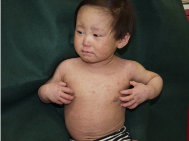 一般社団法人日本アレルギー疾患療養指導士認定機構アレルギー男児