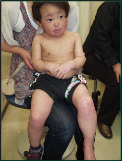 一般社団法人日本アレルギー疾患療養指導士認定機構アレルギー男児5日後